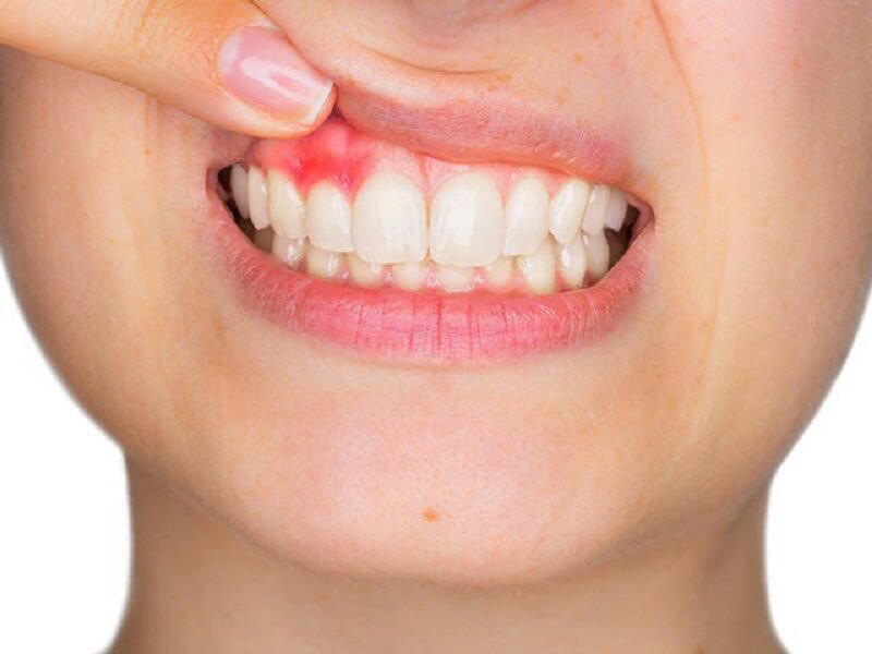 Dấu hiệu nhận biết bị viêm lợi răng.jpg