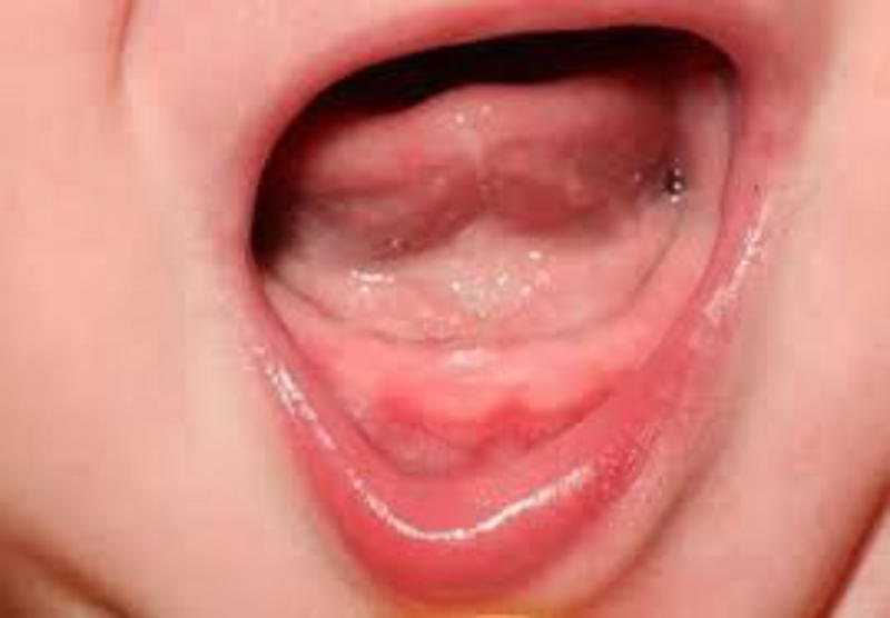 Dấu hiệu nhận biết sốt mọc răng ở trẻ