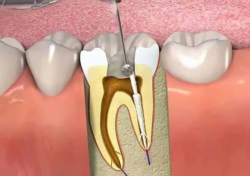 Dấu hiệu răng phải điều trị tủy răng