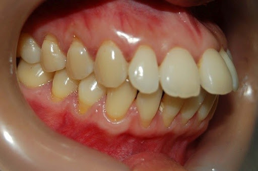Điều trị tình trạng hô nặng vì răng