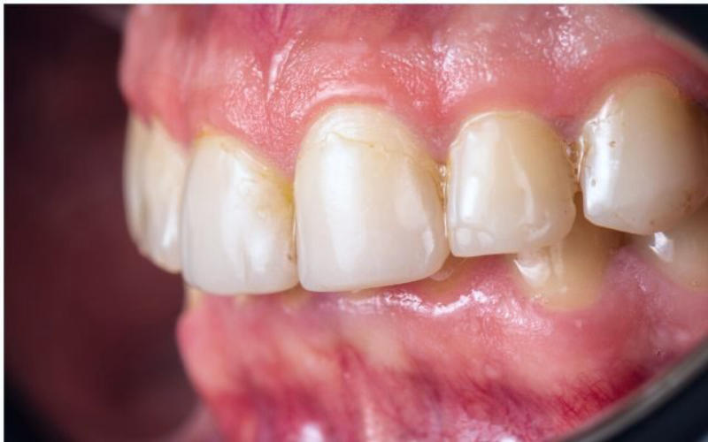Điều trị viêm lợi răng bằng cách sử dụng nước muối