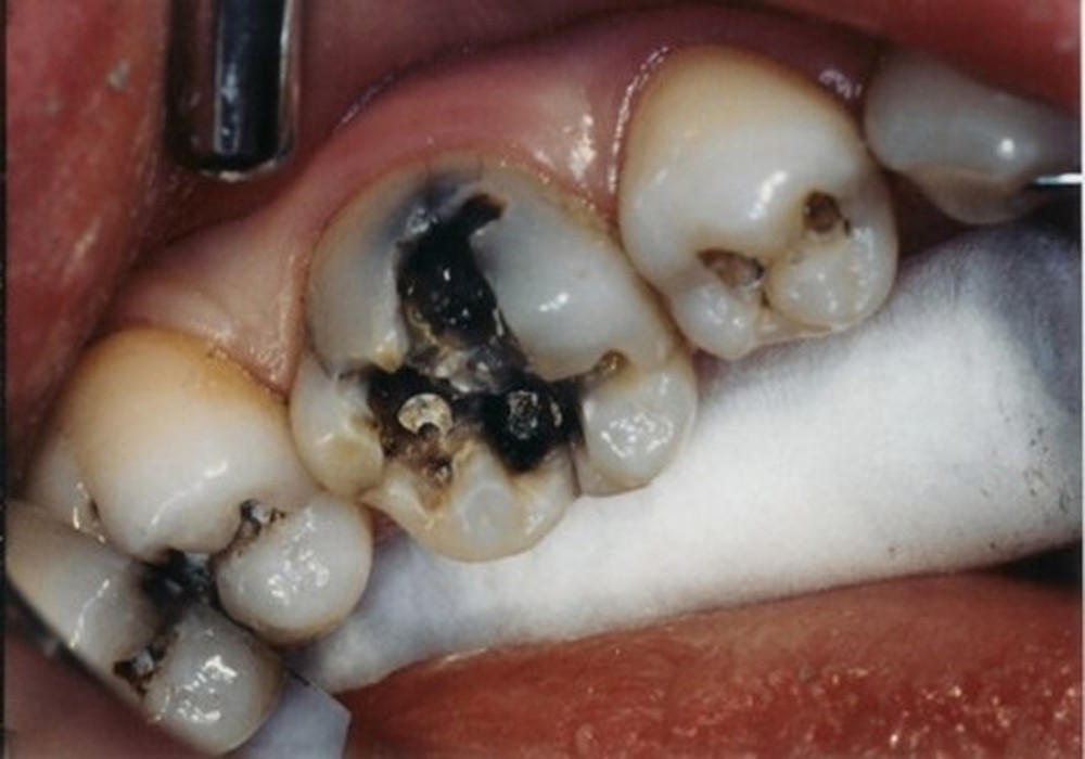 Gây ra các bệnh của tuỷ răng