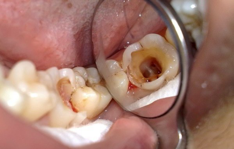 Giai đoạn 3 Sâu ngà răng
