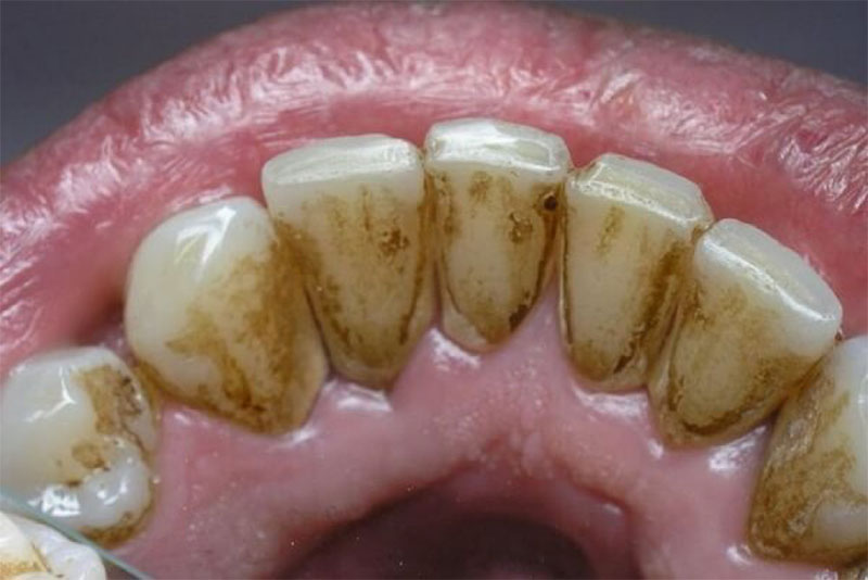 Giải pháp hạn chế hình thành cao răng