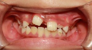 Hàm răng xấu gây nên nhiều ảnh hưởng gì.