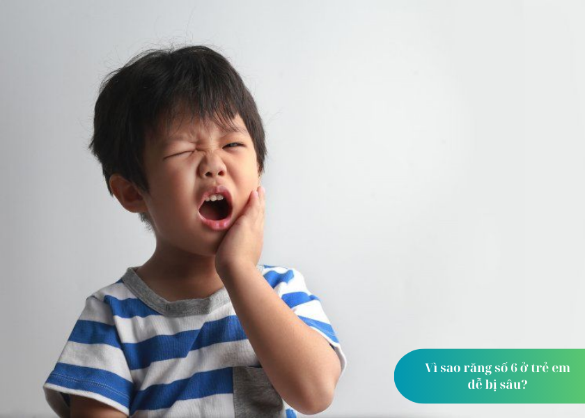 Vì sao răng số 6 ở trẻ em dễ bị sâu?