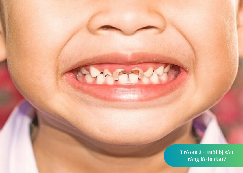 Trẻ em 3-4 tuổi bị sâu răng là do đâu
