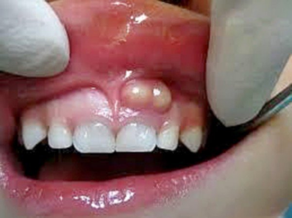 Làm gì trong điều trị viêm chân răng có mủ