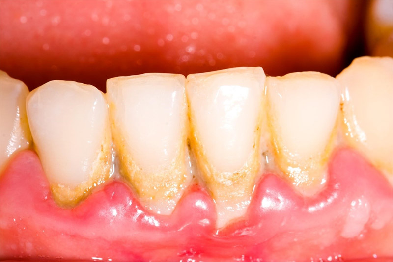 Lấy cao răng tại nhà với muối hiệu quả trong trường hợp nào