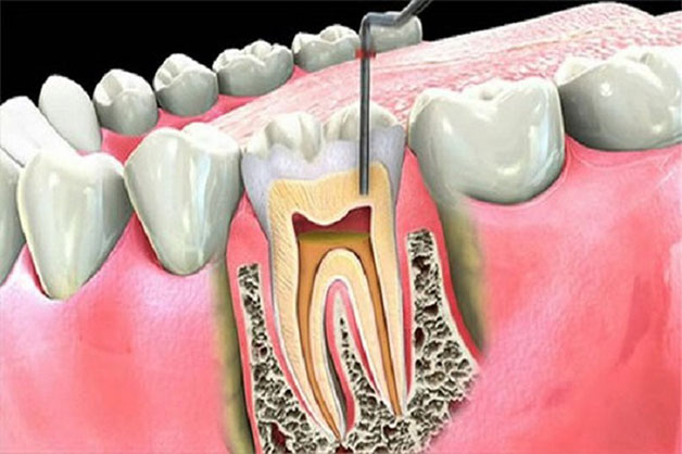 Loại răng nào cần điều trị tủy răng