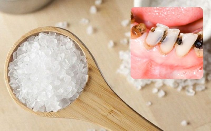 Mẹo chữa đau răng bằng súc miệng với nước muối Mẹo chữa đau răng bằng súc miệng với nước muối