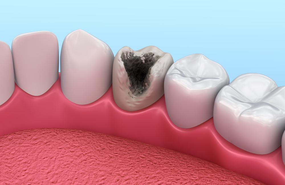 Một số cách trị sâu răng tại nhà an toàn hiệu quả