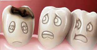 Một số lưu ý để ngăn ngừa tình trạng sâu răng
