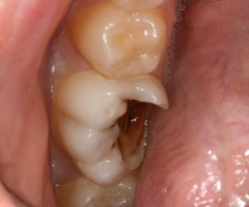 Nguyên nhân bị sâu răng