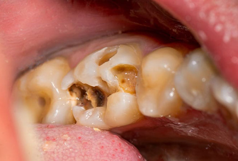 Nguyên nhân khiến răng bị sâu
