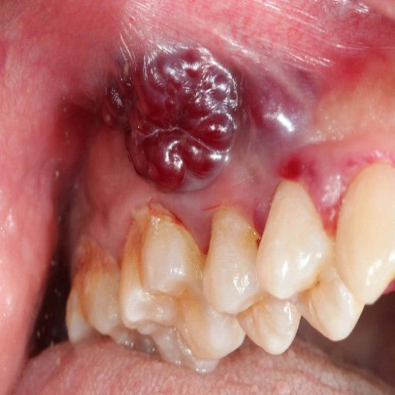 Nhiễm trùng răng