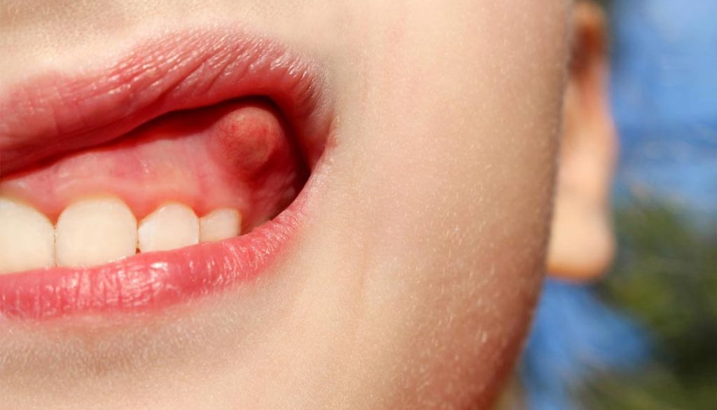 Nhức răng do bệnh áp xe răng