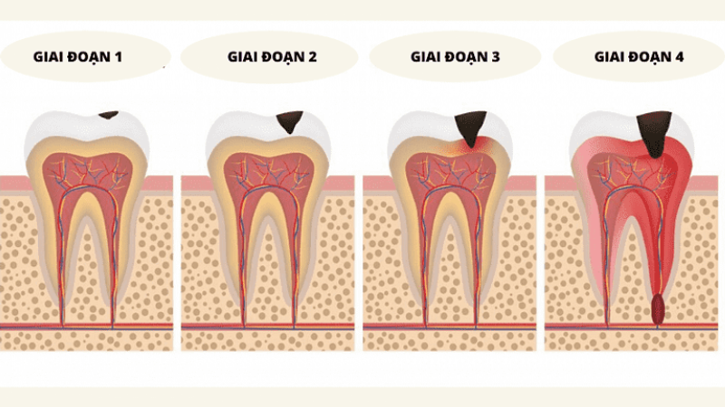 Những giai đoạn của bệnh sâu răng