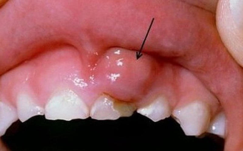 Nướu răng bị sưng do nhiễm trùng.