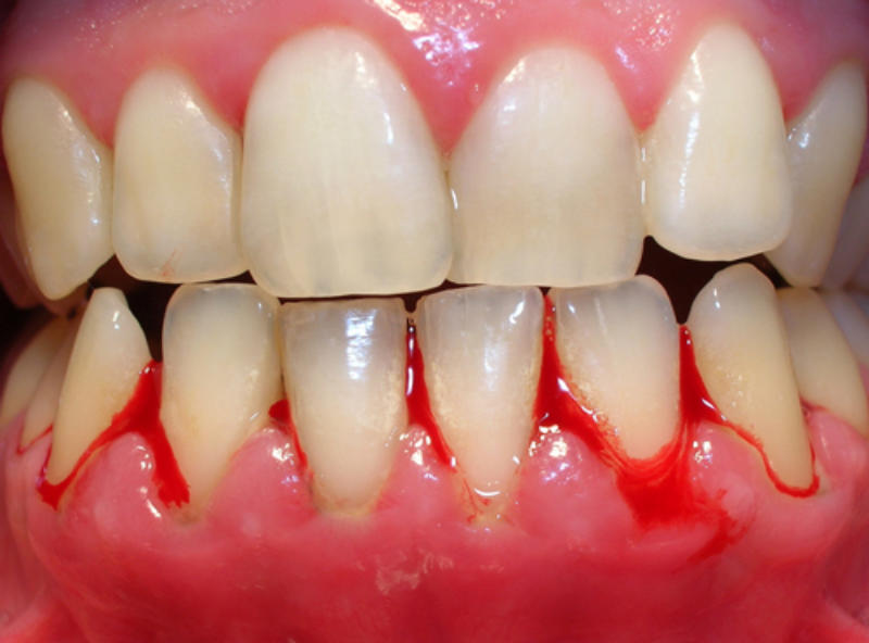 Nguyên nhân gây nướu răng bị sưng