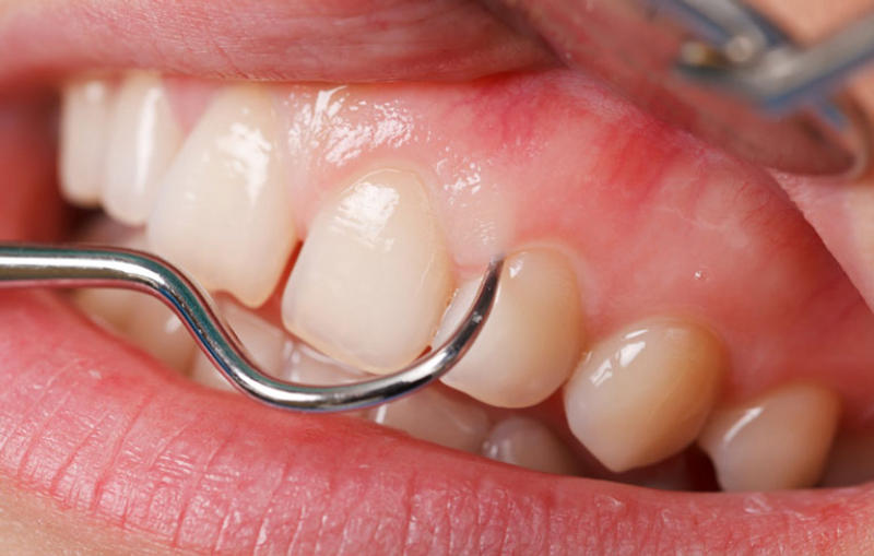 Phương pháp điều trị viêm nướu răng.