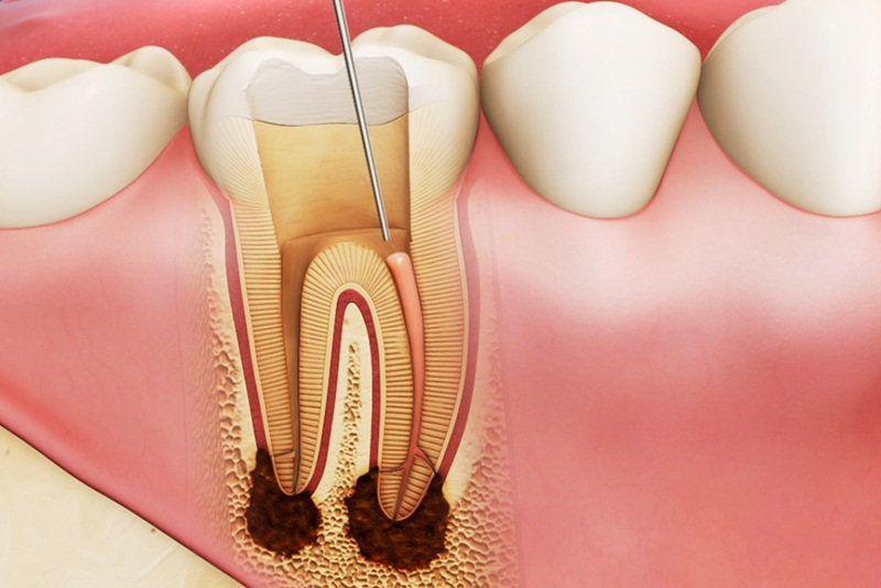 Quá trình điều trị tủy răng thực hiện như thế nào