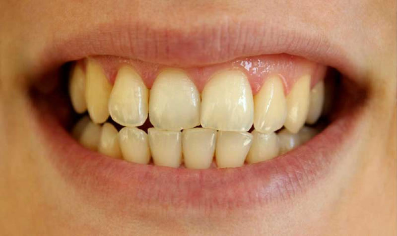 Quên chăm sóc răng miệng khiến răng ố vàng