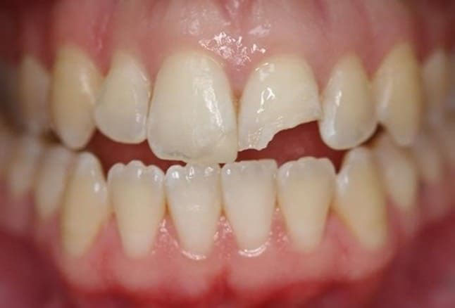 Răng bị mẻ có ảnh hưởng gì không