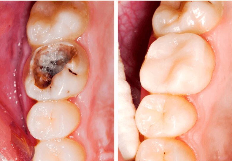 Răng bị sâu lâu năm không nhổ có nguy hiểm không