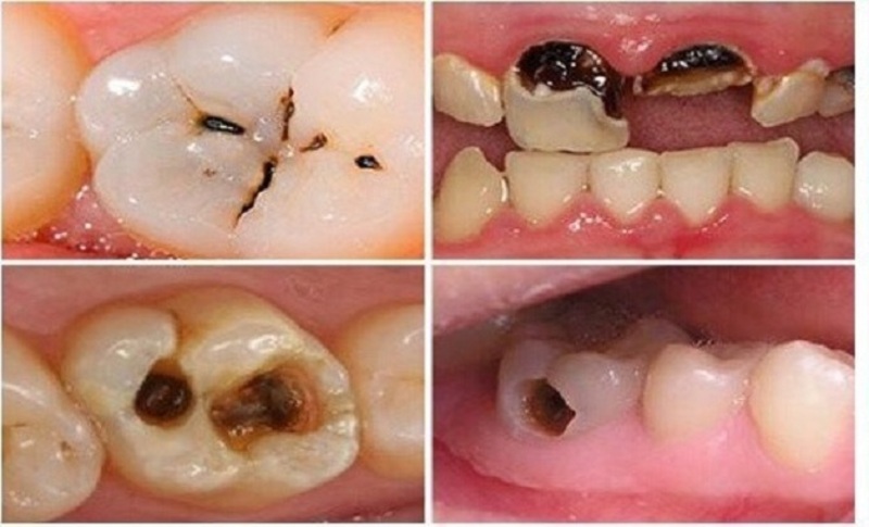 Nguyên nhân răng sâu là gì?