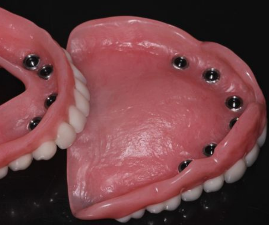 Răng giả tháo lắp trên trụ implant 