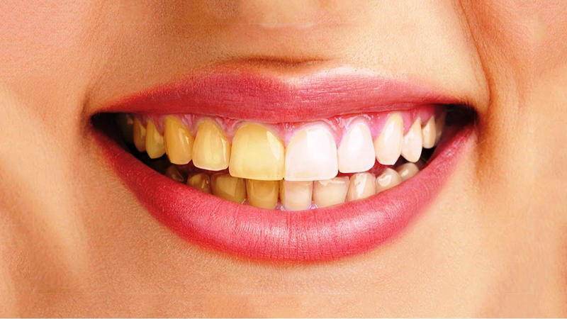 Răng ố vàng ảnh hưởng như thế nào đến sức khỏe