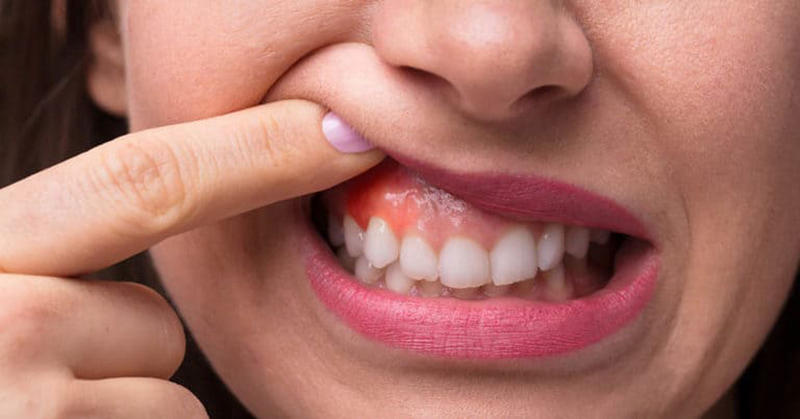 Sinh hoạt ăn uống lành mạnh cũng giúp phòng ngừa viêm lợi răng