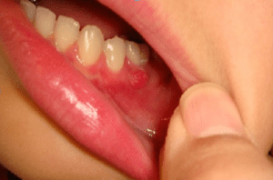 Sử dụng thuốc điều trị viêm nướu, áp xe răng.