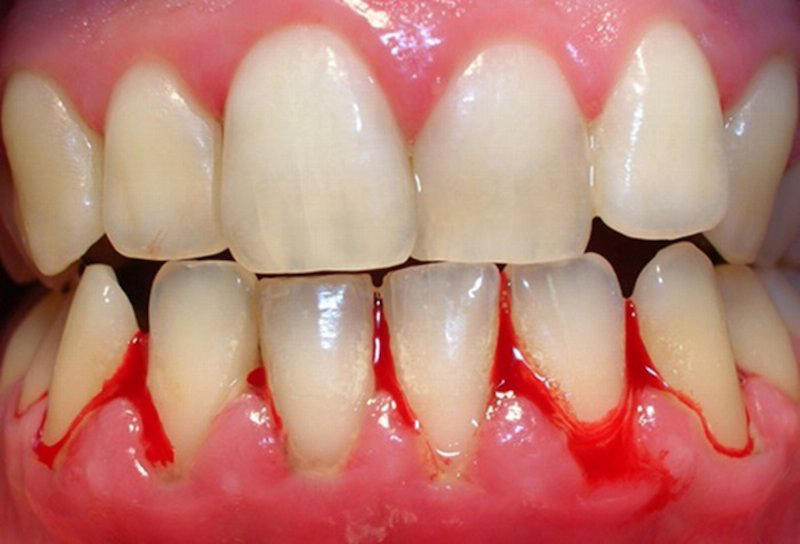 Sưng lợi răng hàm có nguy hiểm không.