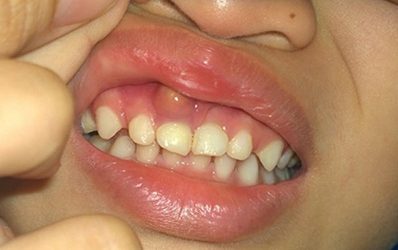 Sưng lợi răng hàm do nhiễm trùng.