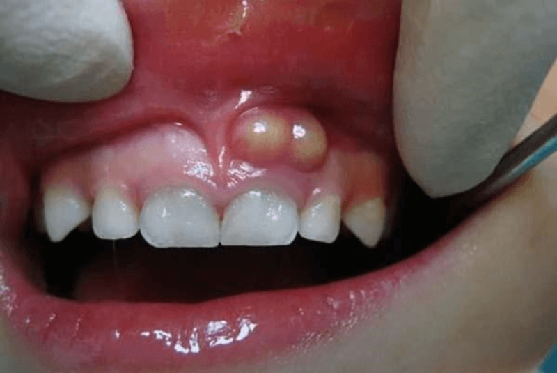 Sưng lợi răng hàm do viêm nha chu.