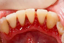  Sưng nướu răng vì nhiễm trùng 