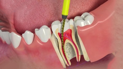 Tại sao cần được điều trị tủy răng
