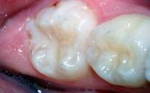 Trám răng ngăn ngừa sâu răng 