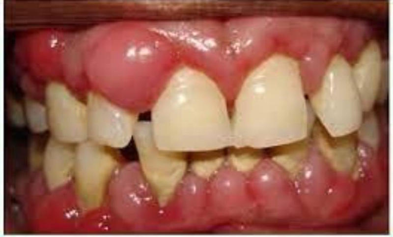 Triệu chứng bị sưng lợi răng hàm.