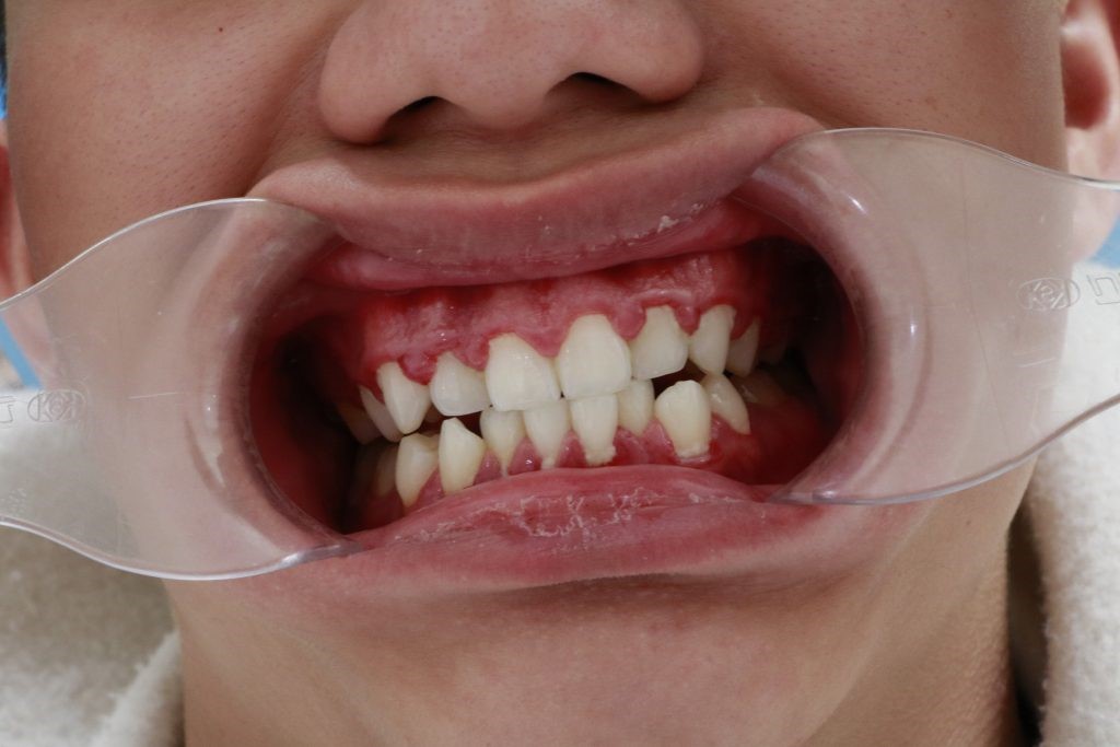 Triệu chứng của viêm nướu răng