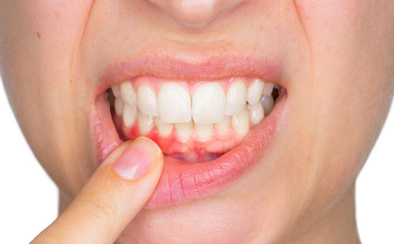 Triệu chứng của viêm nướu răng.