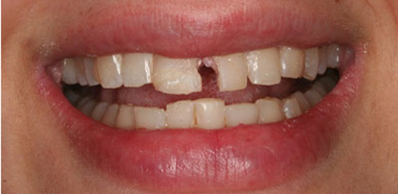 Triệu chứng khi bị mẻ răng