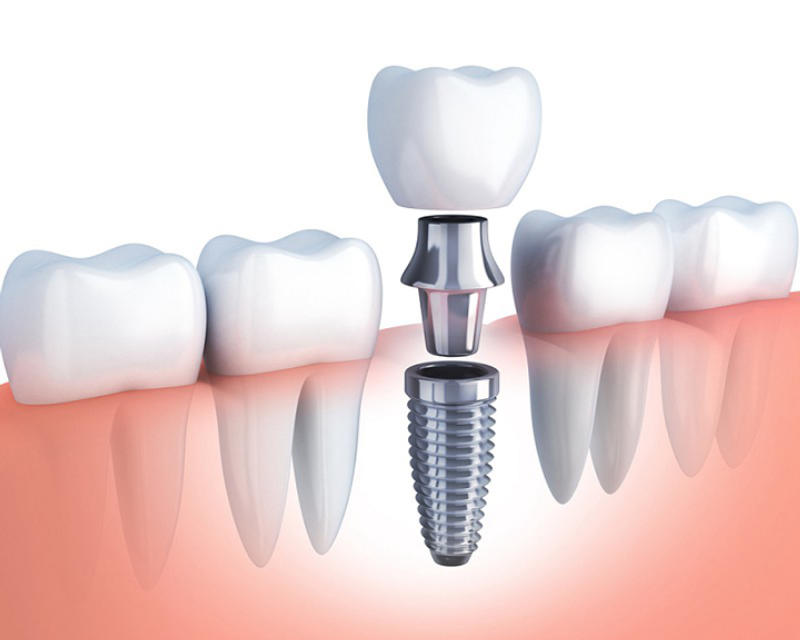 Trồng răng Implant.