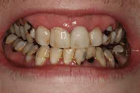 Trường hợp răng bị sâu cần điều trị