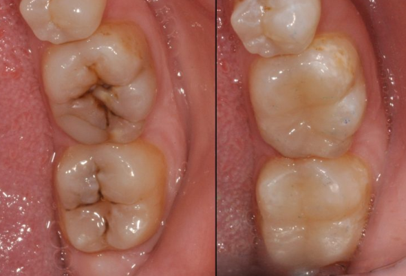 Trường hợp răng bị sâu không cần điều trị