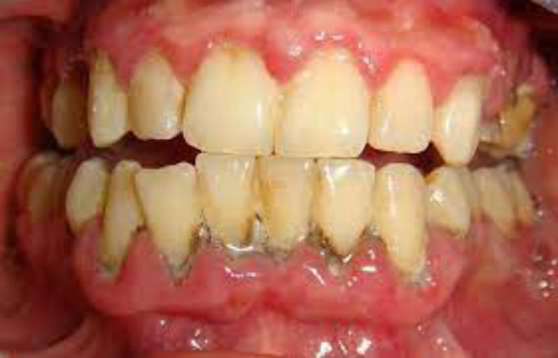 Viêm lợi răng do cao răng