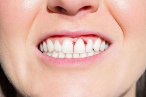 Viêm lợi răng do mảng bám trên răng