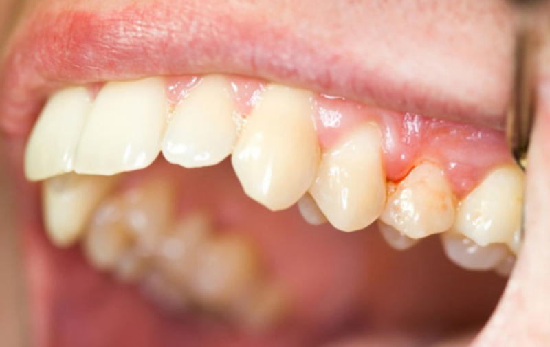 Viêm nướu răng là bệnh gì.